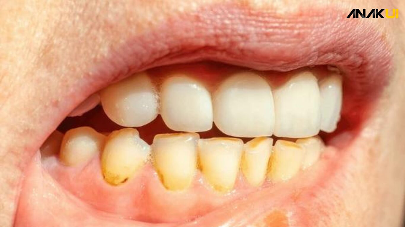 Cara Menghilangkan Karang Gigi